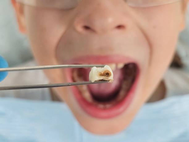 Best Dentist for Tooth Abscess  in Aberdeen, IN